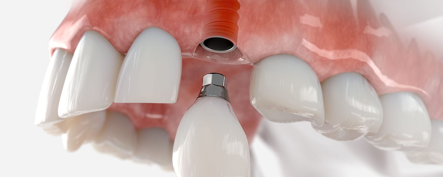 Dental Implants Prices Geneva IL