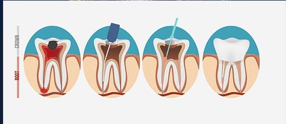 Root-Canal-in-Geneva-Procedure-Dentist