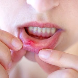 Aphthous ulcers on the lower lip.